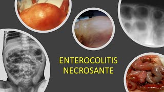 Enterocolitis necrosante [upl. by Cawley]