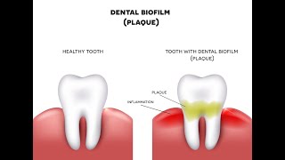 Periodontology  Phases of Plaque Formation [upl. by Aimee]