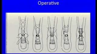 Acute Achilles Tendon Rupture Instructional Lecture and Debates [upl. by Irakuy364]