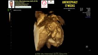 Anencephaly 17 weeks [upl. by Demy466]