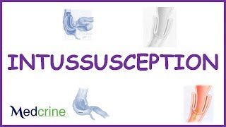 Intussusception  causes types  pathophysiologyfeaturesdx and treatment [upl. by Hendricks44]