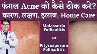 Fungal Acne Treatment In Hindi  फ़ंगल ऐक्नी का इलाज  Malassezia or Pityrosporum Folliculitis [upl. by Constancy]