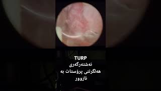 Transurethral resection of the prostate TURP الوليدالشمسان تراويح turp prostate cystoscopy [upl. by Airet]