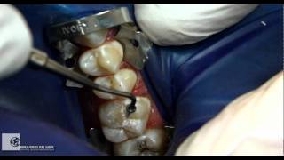 Restorative Procedure by Dr Douglas Terry [upl. by Layol]