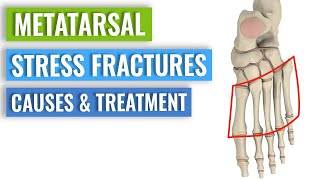 Metatarsal Stress Fractures  Causes Treatment Prevention [upl. by Nac962]