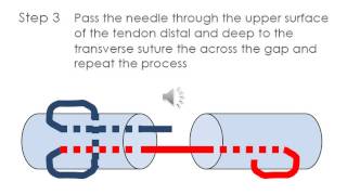 Flexor tendon repair  modified Kesser [upl. by Schuman]