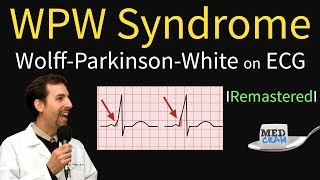 Wolff Parkinson White Syndrome on ECG  WPW Pathophysiology [upl. by Barna196]