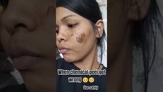 burning the face 30 salicylic acid chemical peel got wrong 🥺🥺 chemicalpeeling [upl. by Anilasor]