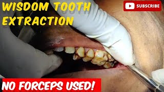 Wisdom Tooth Extraction Using Cryers Elevator toothextractions dental wisdomteeth dentist [upl. by Zephan]