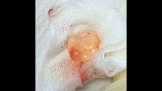 Cyst explodes [upl. by Egiedan]