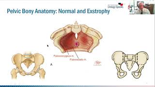 1000 Exstrophies Lesson Learned for Families and Physicians [upl. by Pru]