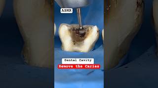 Remove the Caries cavity teethsmiledrmassidental [upl. by Aneed582]