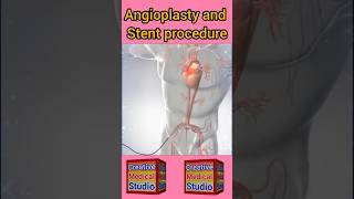 Angioplasty technique  Stent and Angioplasty procedure shorts [upl. by Taite]