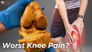 How Arthritis Destroys Your Knees [upl. by Airan]