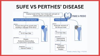 Slipped Upper Femoral Epiphysis SUFE vs Perthes Disease [upl. by Macilroy]