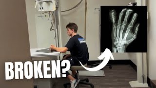 TEENAGER SLAMS FINGER IN CAR DOOR  DOCTOR VISIT AND XRAYS TO FIND OUT  FIRST BROKEN BONE [upl. by Quartet]