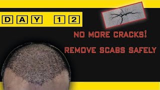 FUE Hair Transplant Day 12 Post Op  No Scabs and Cracks [upl. by Tobi590]