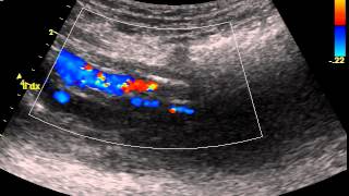 ILIAC ARTERY STENOSIS [upl. by Airetnuhs]