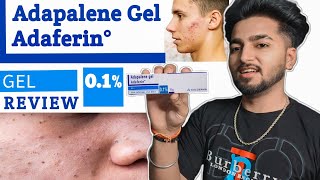 Adapalene Gel Adaferin 01 Review In Hindi  Best Gel For Removing Blackheads and Whiteheads [upl. by Clauddetta361]