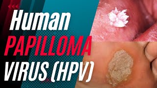 Human Papilloma Virus HPV  Signs Symptoms Causes treatment and Can it be Cured [upl. by Enovahs]