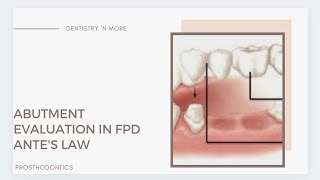 ABUTMENT SELECTION IN FPD [upl. by Tiffy]