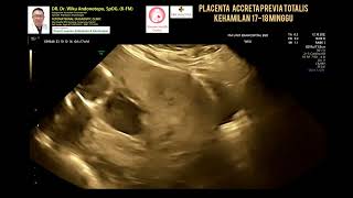 Placenta Accreta Previa Totalis [upl. by Ok846]