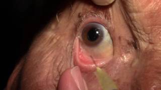 Right Intravitreal Injection of Eylea [upl. by Thema522]