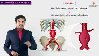 Abdominal aortic aneurysm  Usmle step 1  Causes  Signs amp symptoms  diagnosis  treatment [upl. by Aihsela]