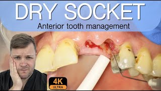 Alveolar Osteitis Management  4K Resolution [upl. by Olihs]