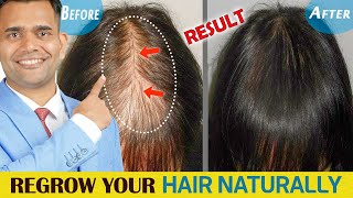 How To Stop Hair fall and Regrow Your Hair Naturally  Dr Vivek Joshi [upl. by Ettegdirb]