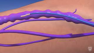 Guiding Light An Animated Journey through Endovenous Thermal Ablation [upl. by Murrah]