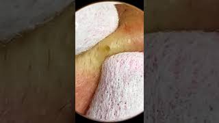 Removing Acne acnes skincare skintreatment [upl. by Sirhc]