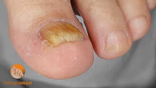 Onychomycosis and spicule Documenting podology cases [upl. by Eselrahc48]