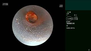 Complex Tracheal Stenosis  Rigid Bronchoscopy  CRE balloon dilation  Cryoablation [upl. by Ispep986]