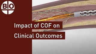 The impact of Chronic Outward Force COF on clinical outcomes [upl. by Fidelity]