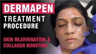 Dermapen Treatment Procedure  Skin Rejuvenation amp Collagen Boosting [upl. by Dlonra]