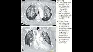 Daptomycin assoziierte eosinophile Pneumonitis [upl. by Doti]