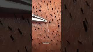 tenacious hair tweezers hairremoval asmrsatisfying [upl. by Auqkinahs]