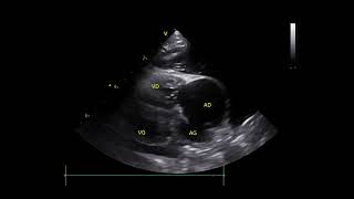 Eisenmengers syndrome and an atrial septal defect in young 🐈 [upl. by Phare159]