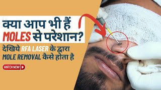 Mole removal by Laser LIVE  Mole removal in Delhi  Best Mole Treatment  SkinQure [upl. by Stoughton910]