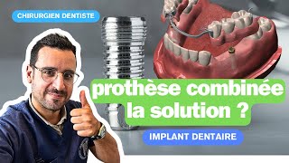 Dents mobiles  les implants dentaire pour stabiliser un appareil [upl. by Esbenshade]