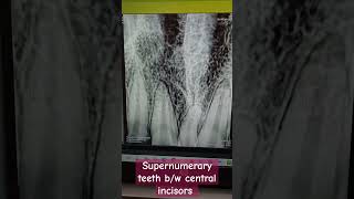 supernumerary teeth bw central incisors dentalcafe4331 [upl. by Aynatahs]