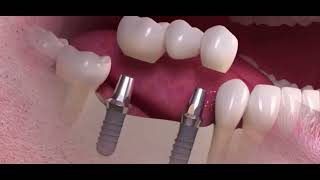 Le BRIDGE sur IMPLANTS dentaires  le pont dentaire sur implants [upl. by Nylirej]