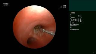 Airway foreign body removal  Bronchoscopy [upl. by Lobel972]