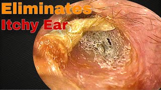 The Itching Stopped after Removing Earwax  Doctor Anh [upl. by Ecnerret]