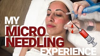 What Microneedling is REALLY Like  My Microneedling Experience  LASH BOSSES [upl. by Zosema511]