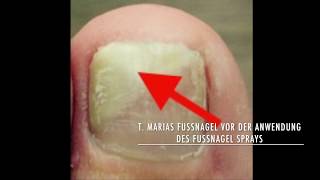 Fußnägel pflegen Fußpflege mit dem Fußnagel Spray selber machen [upl. by Attalie]