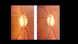 Optic atrophy Primary Secondary glaucomatous optic atrophy AnterogradeRetrograde AION RNFL [upl. by Cosmo]