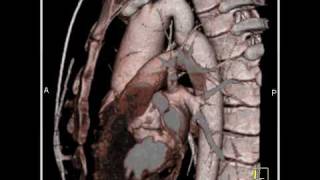 Cardiac Dilated aortic root and aortic stenosis 4 of 6 [upl. by Bunow]