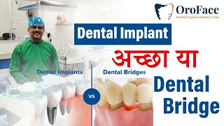 Dental Implant या Dental Bridge क्या है बेहतर [upl. by Poll]